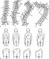 stepeni-tyazhesti-skolioza.jpg